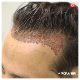 Power Greft Hair Transplant Center