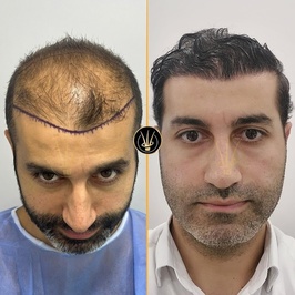 Real Of Hair - Hair Transplant Center in Turkey