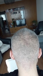 S&D Hair Transplant