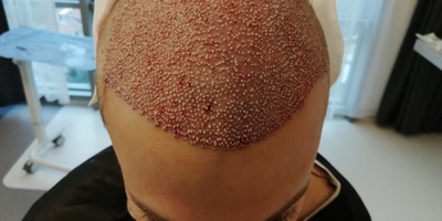 Saç Ekim Kliniği - Saç Ekim Merkezi - İstanbul Saç Ekim