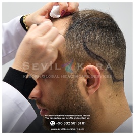 Sevil KARA - Reborn : Hair Transplant