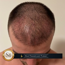 Si Hair Transplant in Turkey