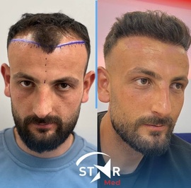 STARMEDTURKEY - Saç Ekimi ve Tedavileri