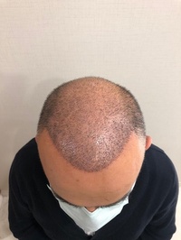 Techestetik Saç Ekim Merkezi - Hair Transplant Istanbul