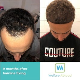 Welfare Abroad | FUE Hair Transplant and Cosmetic Surgery