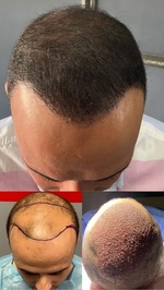Worbimed l Hair Transplant Turkey