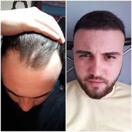 Zeymed Hair Clinic